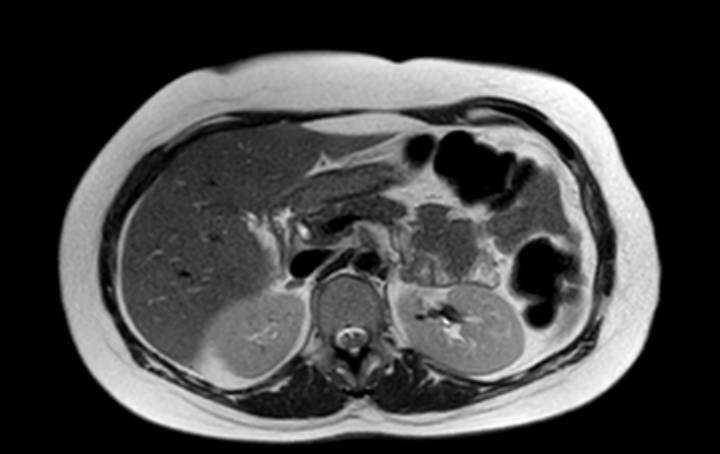 Colon adenocarcinoma with Krukenberg tumors, advanced pregnancy (Radiopaedia 67279-76645 Axial T2 59).jpg