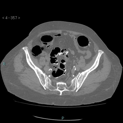 File:Colonic lipomas (Radiopaedia 49137-54244 Axial bone window 159).jpg