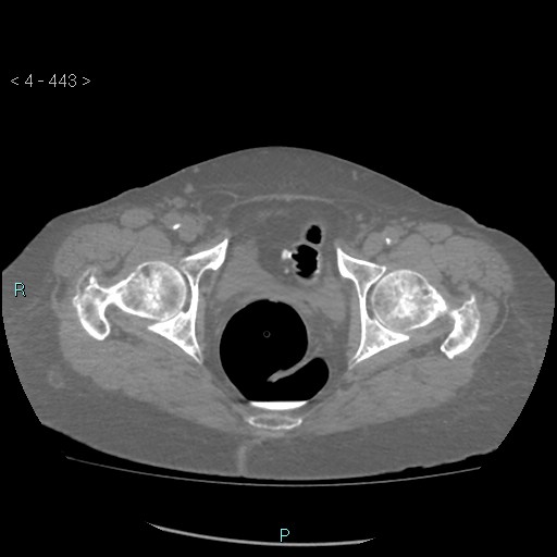 Colonic lipomas (Radiopaedia 49137-54244 Axial bone window 197).jpg