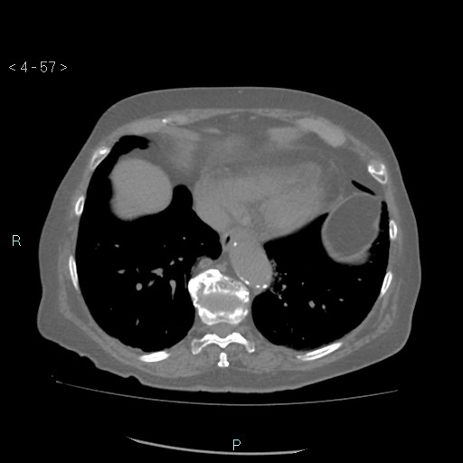 Colonic lipomas (Radiopaedia 49137-54244 Axial bone window 25).jpg