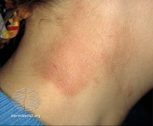 File:Eczema on neck (DermNet NZ dermatitis-s-atopic31).jpg