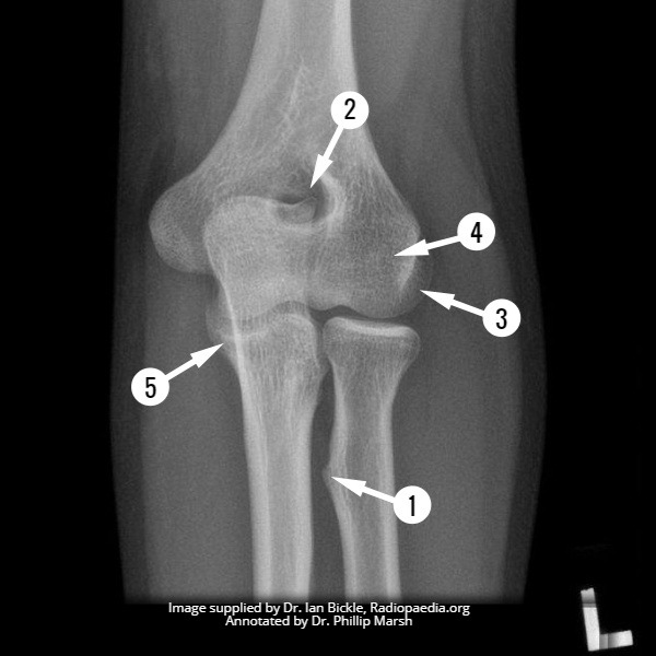 File:Elbow AP radiograph (anatomy quiz) (Radiopaedia 60305).jpg