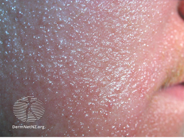 File:Facial dermatitis (DermNet NZ dermatitis-acd-q15).jpg