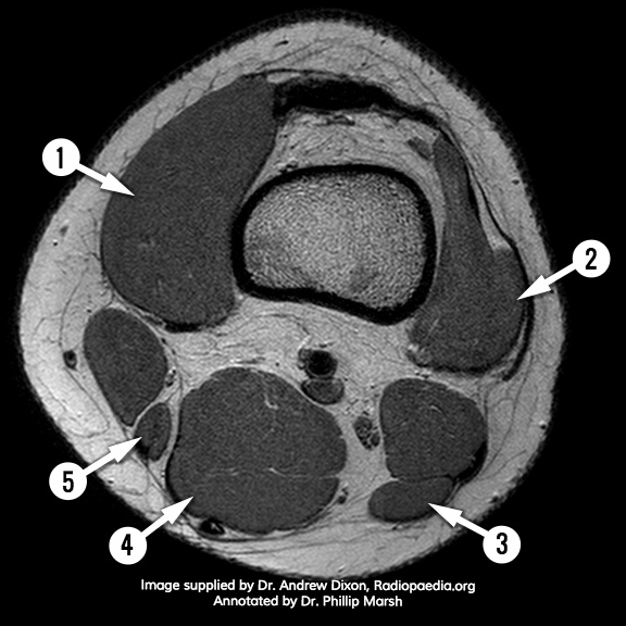 File:MRI knee - axial (anatomy quiz) (Radiopaedia 61604).jpg