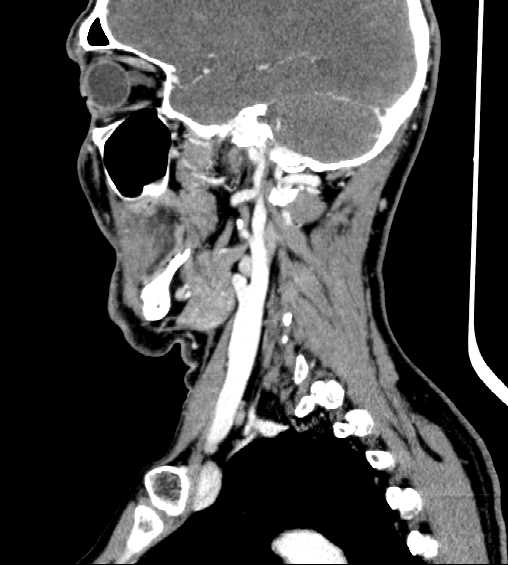 File:Nasopharyngeal carcinoma - infiltrating the clivus (Radiopaedia 62583-70875 C 37).jpg