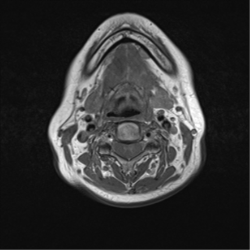 File:Nasopharyngeal carcinoma with cerebral abscess (Radiopaedia 43018-46273 Axial T1 32).png