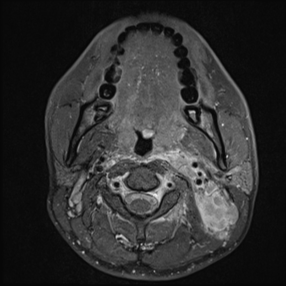 Nasopharyngeal carcinoma with skull base invasion (Radiopaedia 53415-59485 Axial T1 C+ fat sat 40).jpg