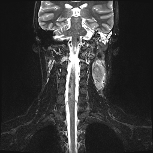 Nasopharyngeal carcinoma with skull base invasion (Radiopaedia 53415-59485 Coronal T2 fat sat 9).jpg
