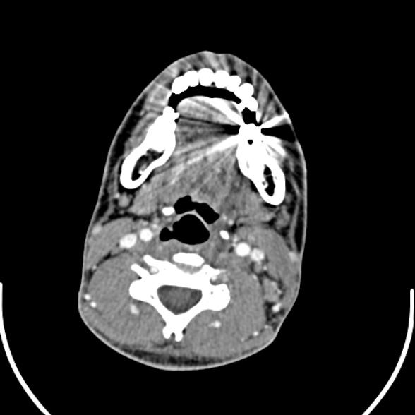 Nasopharyngeal carcinoma with skull base invasion (Radiopaedia 53415-59705 A 119).jpg