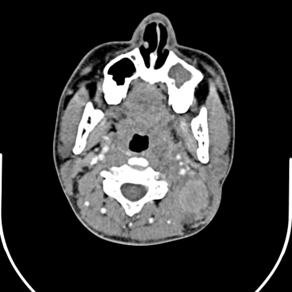 File:Nasopharyngeal carcinoma with skull base invasion (Radiopaedia 53415-59705 A 82).jpg