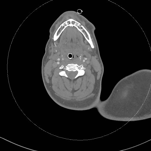 Neck CT angiogram (intraosseous vascular access) (Radiopaedia 55481-61945 B 193).jpg