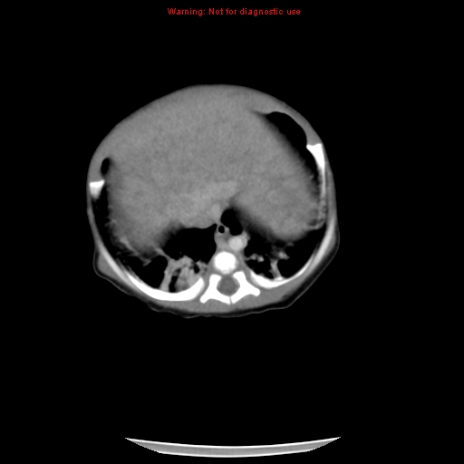 File:Neonatal neuroblastoma (Radiopaedia 9564-10223 A 13).jpg