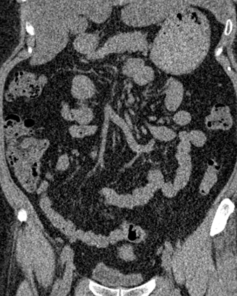 File:Nephrostomy for urosepsis (Radiopaedia 26180-26330 non-contrast 36).jpg
