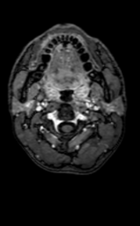 Neuro-Behçet disease (Radiopaedia 90112-107294 Axial T1 C+ 230).jpg
