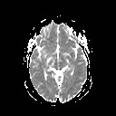 File:Neuro-Behcet's disease (Radiopaedia 21557-21505 Axial ADC 10).jpg