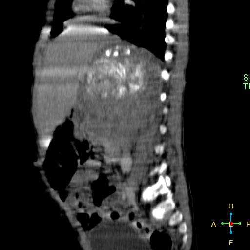 File:Neuroblastoma (Radiopaedia 24751-25016 C 18).jpg