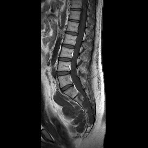File:Neurofibromatosis type 1- extensive spinal involvement and Christmas tree sign (Radiopaedia 60610-68332 Sagittal T1 8).jpg