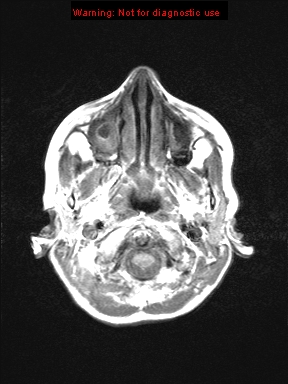 File:Neurofibromatosis type 1 with optic nerve glioma (Radiopaedia 16288-15965 Axial T1 23).jpg