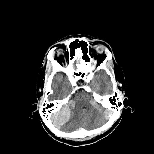 File:Neurofibromatosis type 2 (Radiopaedia 25389-25637 Axial C+ 19).jpg