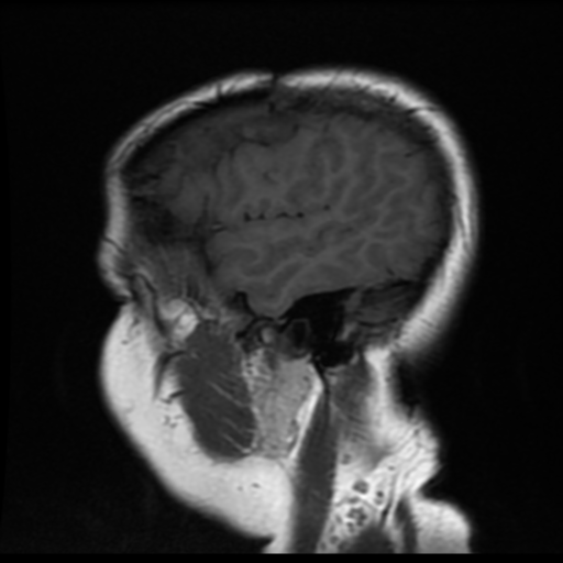 File:Neurofibromatosis type 2 (Radiopaedia 45229-49247 Sagittal T1 18).png