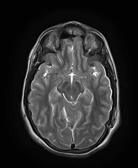 File:Neurofibromatosis type 2 (Radiopaedia 66211-75401 Axial T2 15).jpg