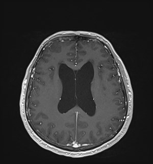 Neurofibromatosis type 2 (Radiopaedia 79097-92049 Axial T1 C+ 125).jpg