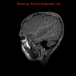File:Neurofibromatosis type 2 (Radiopaedia 8953-9730 Sagittal T1 18).jpg