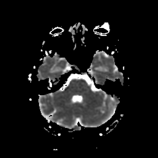 File:Neurofibromatosis type 2 - bilateral acoustic neuromata (Radiopaedia 40060-42566 Axial ADC 6).png