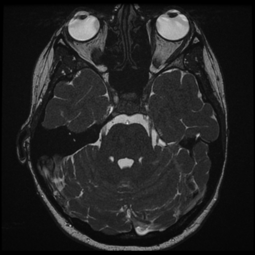 File:Neurofibromatosis type 2 - bilateral acoustic neuromata (Radiopaedia 40060-42566 Axial FIESTA 56).png