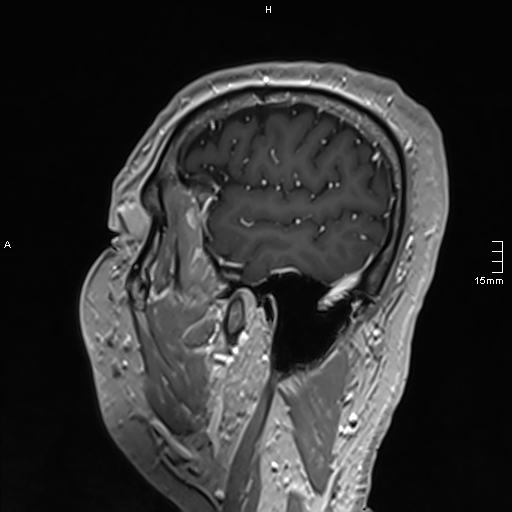 Neurosarcoidosis - involvement of the mesial temporal lobes (Radiopaedia 67429-76820 Sagittal T1 C+ 31).jpg