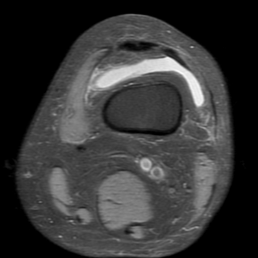 File:Non-displaced patella fracture (Radiopaedia 15932-15582 Axial PD fat sat 2).jpg
