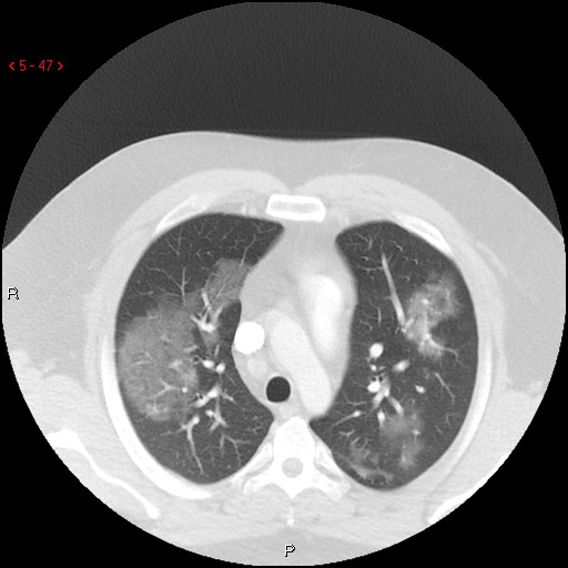 File:Non-specific interstitial pneumonitis (Radiopaedia 27044-27222 Axial lung window 38).jpg