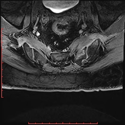Non Hodgkin's lymphoma with metastasis to spine (Radiopaedia 54844-61103 Axial T1 C+ fat sat 44).jpg