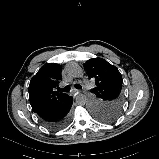 File:Non Hodgkin lymphoma in a patient with ankylosing spondylitis (Radiopaedia 84323-99621 Axial non-contrast 11).jpg