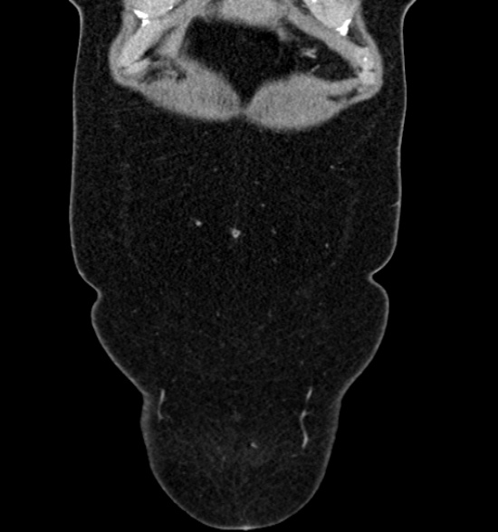 Normal CT intravenous urogram (Radiopaedia 39444-41759 A 160).jpg