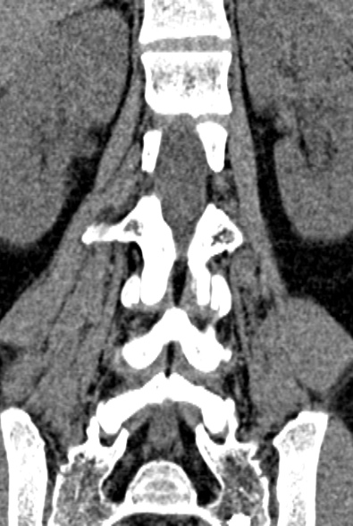 Normal CT lumbar spine (Radiopaedia 53981-60118 F 58).jpg