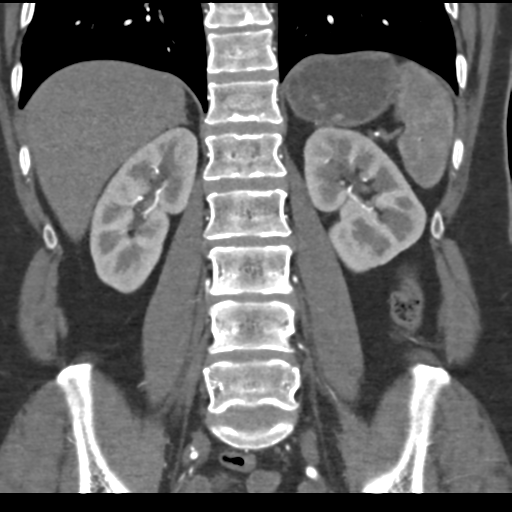 File:Normal CT renal artery angiogram (Radiopaedia 38727-40889 B 52).png