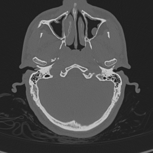 Normal CT skull (Radiopaedia 40798-43459 A 29).png