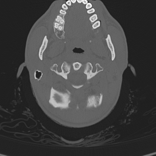 Normal CT skull (Radiopaedia 40798-43459 A 5).png