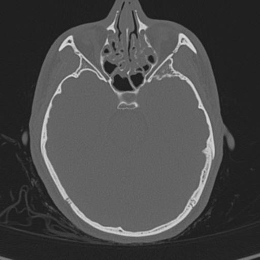 Normal CT skull (Radiopaedia 40798-43459 A 54).png