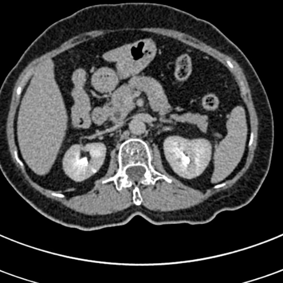 File:Normal CT split bolus study of the renal tract (Radiopaedia 48631-53634 Axial split bolus 51).jpg