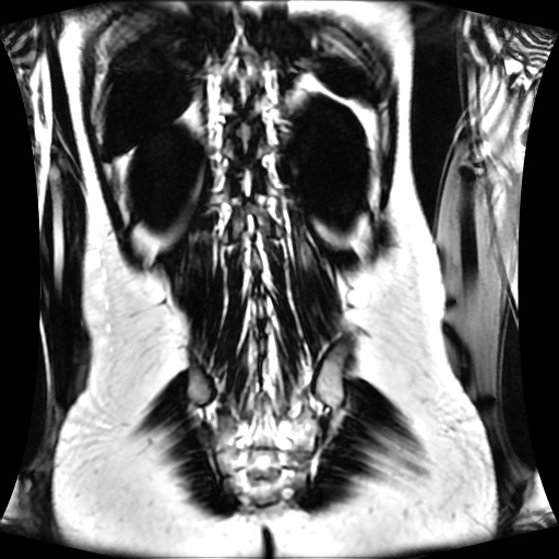 Normal MRI abdomen in pregnancy (Radiopaedia 88001-104541 N 113).jpg