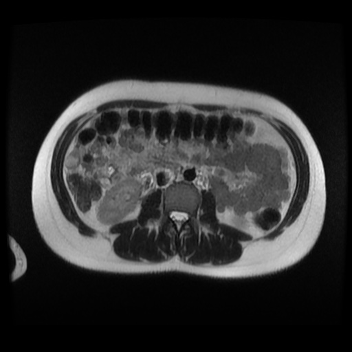Normal MRI abdomen in pregnancy (Radiopaedia 88003-104546 Axial T2 17).jpg
