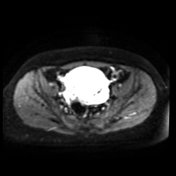 Normal MRI abdomen in pregnancy (Radiopaedia 88005-104548 Axial DWI 21).jpg