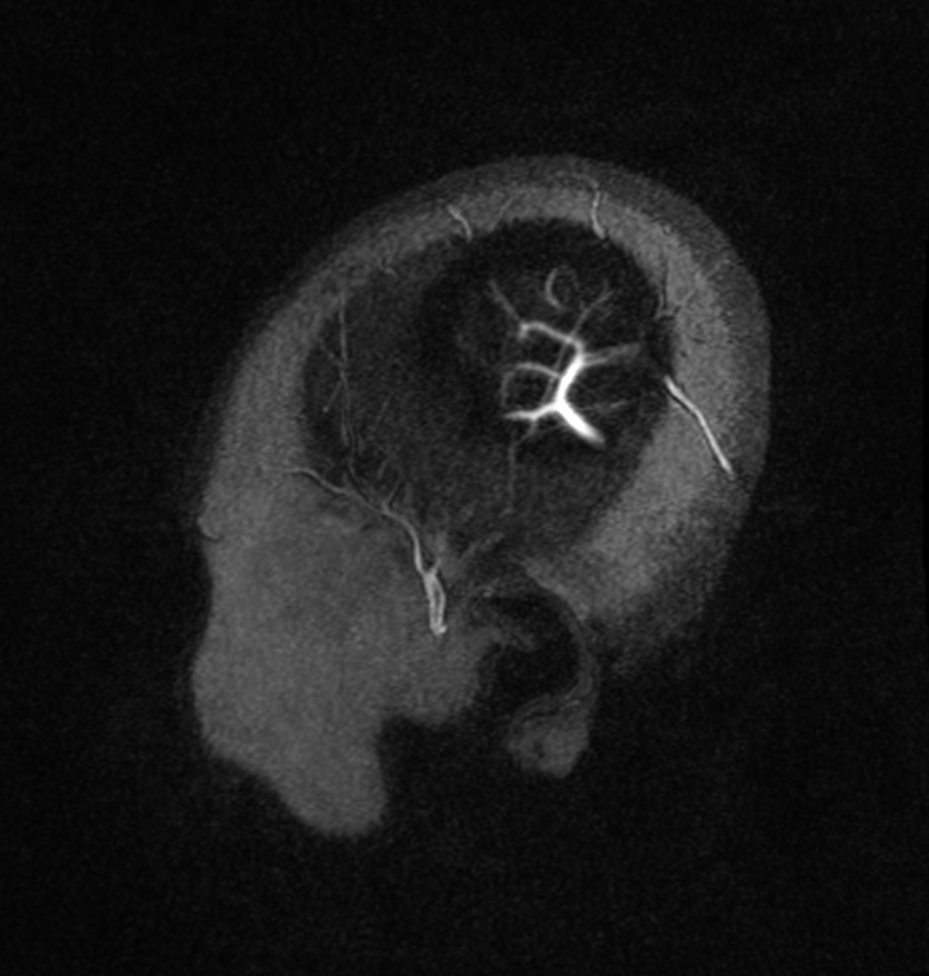 Normal brain MRI and venogram (Radiopaedia 39554-41862 Sagittal MRV 1).jpg