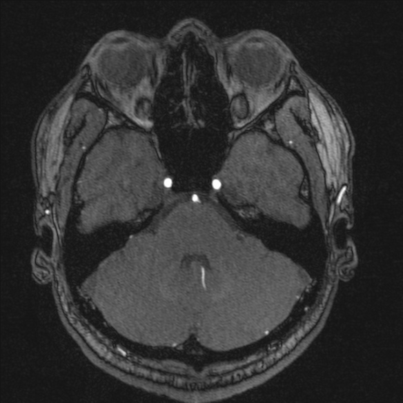 Normal brain MRI including MRA (Radiopaedia 48748-53763 Axial MRA 51).jpg