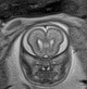 Normal brain fetal MRI - 22 weeks (Radiopaedia 50623-56050 Coronal T2 Haste 17).jpg