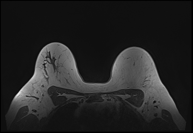 File:Normal breast MRI - dense breasts (Radiopaedia 80454-93850 Axial T1 172).jpg