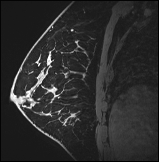 Normal breast MRI - dense breasts (Radiopaedia 80454-93850 I 121).jpg