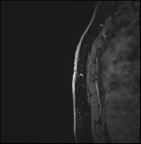 Normal breast MRI - dense breasts (Radiopaedia 80454-93850 I 166).jpg